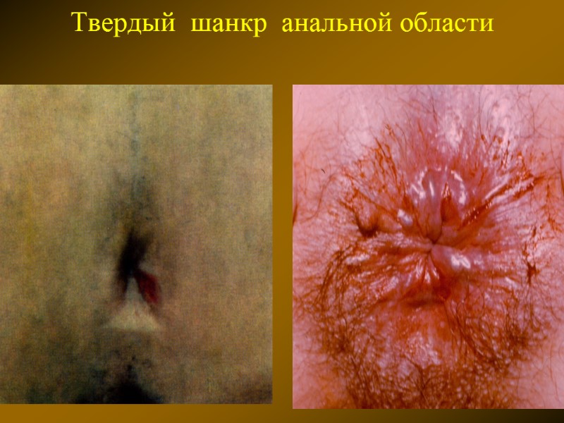 Твердый  шанкр  анальной области